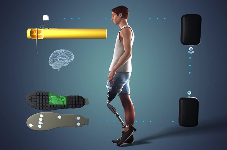 Neurotechnology advancements bring promise to amputee